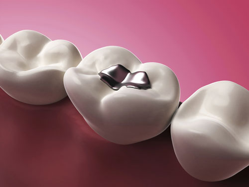 A 3D rendering of a tooth with a metal filling