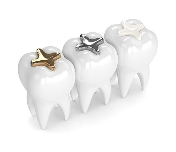 Image of dental fillings.