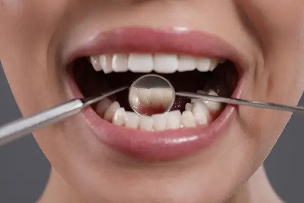 Dental tools inspecting a patient's teeth and gums during a periodontal checkup at San Francisco Dental Arts in San Francisco, CA