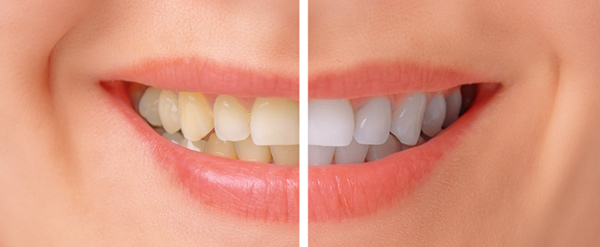 Yellow teeth compared to white teeth.