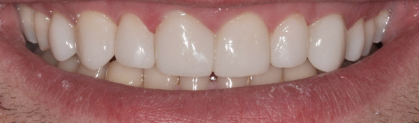 Photo of mouth after bioclear veneers.