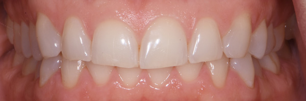 Photo of mouth before bioclear veneers.