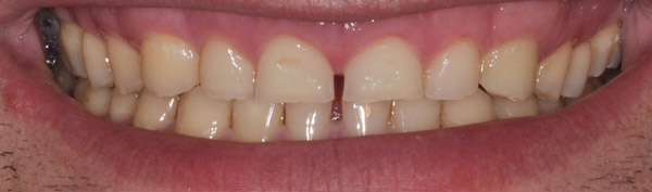 Photo of mouth before bioclear veneers.
