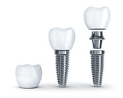 a diagram showing the parts of a dental implant at San Francisco Dental Arts in San Francisco, CA a diagram showing the parts of a dental implant at San Francisco Dental Arts in San Francisco, CA