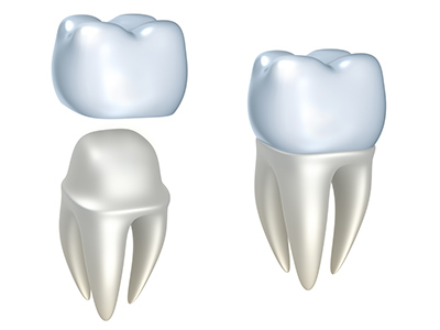 How Long Does it Take to Get a Dental Crown?