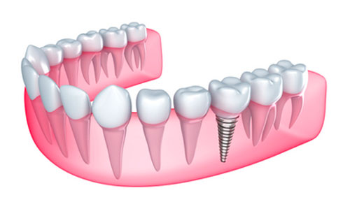 Choosing Between Dental Implants and Dentures