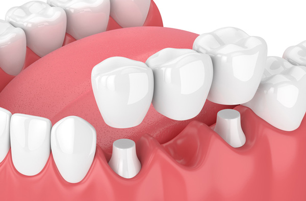 Rendering of jaw with dental bridge done at San Francisco Dental Arts in San Francisco, CA Rendering of jaw with dental bridge done at San Francisco Dental Arts in San Francisco, CA