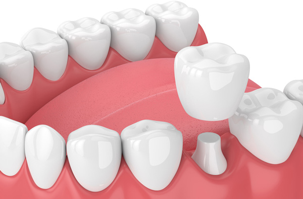 Rendering of jaw with dental crown from San Francisco Dental Arts in San Francisco, CA Rendering of jaw with dental crown from San Francisco Dental Arts in San Francisco, CA