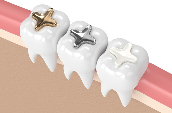 Rendering of teeth with 3 filling materials at San Francisco Dental Arts in San Francisco, CA