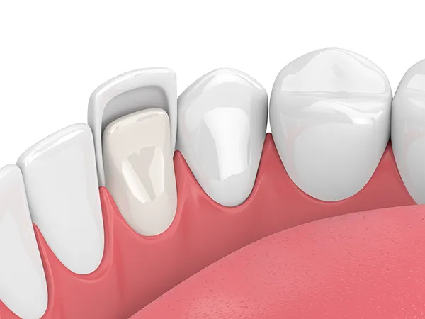 Close up 3D rendering of a thin porcelain veneer being applied to a tooth at San Francisco Dental Arts in San Francisco, CA Close up 3D rendering of a thin porcelain veneer being applied to a tooth at San Francisco Dental Arts in San Francisco, CA
