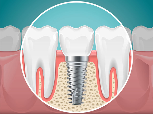 Diagram of a tooth replaced with a dental implant from San Francisco Dental Arts in San Francisco, CA