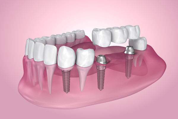 3D rendering of mouth with multiple dental implants from San Francisco Dental Arts in San Francisco, CA