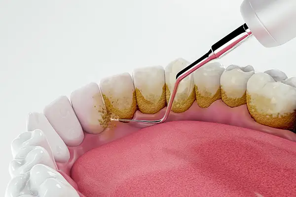 Close up 3D rendering of dirty teeth being cleaned and restored by a dental tool at San Francisco Dental Arts in San Francisco, CA