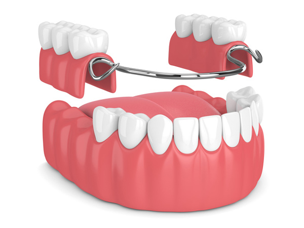 Rendering of removable partial denture from San Francisco Dental Arts in San Francisco, CA