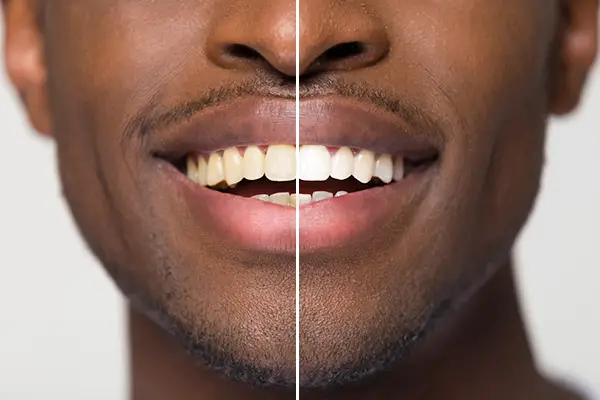 Close up comparison of before and after teeth whitening treatment on a man's smile San Francisco, CA