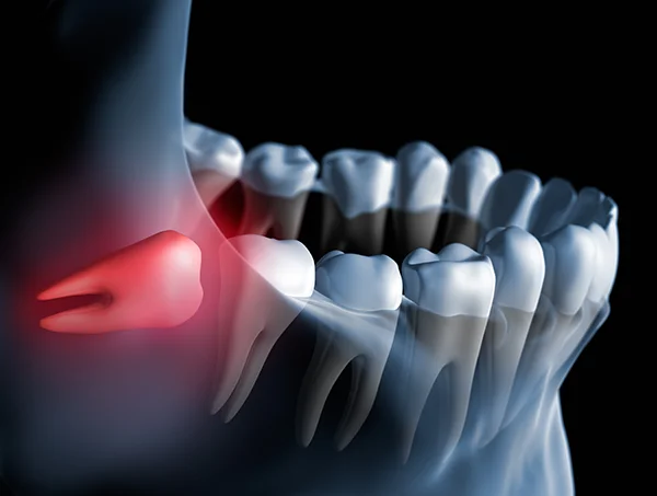 3D rendered xray of an impacted wisdom tooth butting against the tooth next to it 3D rendered xray of an impacted wisdom tooth butting against the tooth next to it