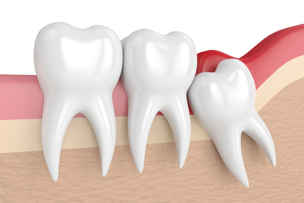 Illustration of an impacted wisdom tooth from San Francisco Dental Arts in San Francisco, CA